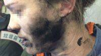 锂离子电池供电的耳机在澳大利亚航班上在女人的脸上爆炸