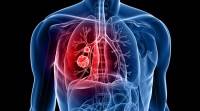 石墨烯生物传感器可以早期诊断肺癌